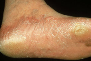 Hypertrophe Onychomykose